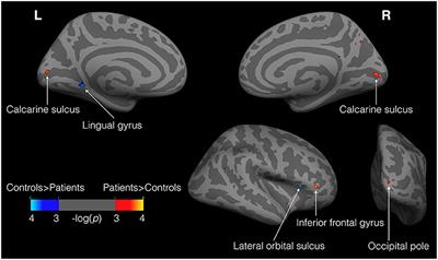 Brief Postnatal Visual Deprivation Triggers Long-Lasting Interactive Structural and Functional Reorganization of the Human Cortex